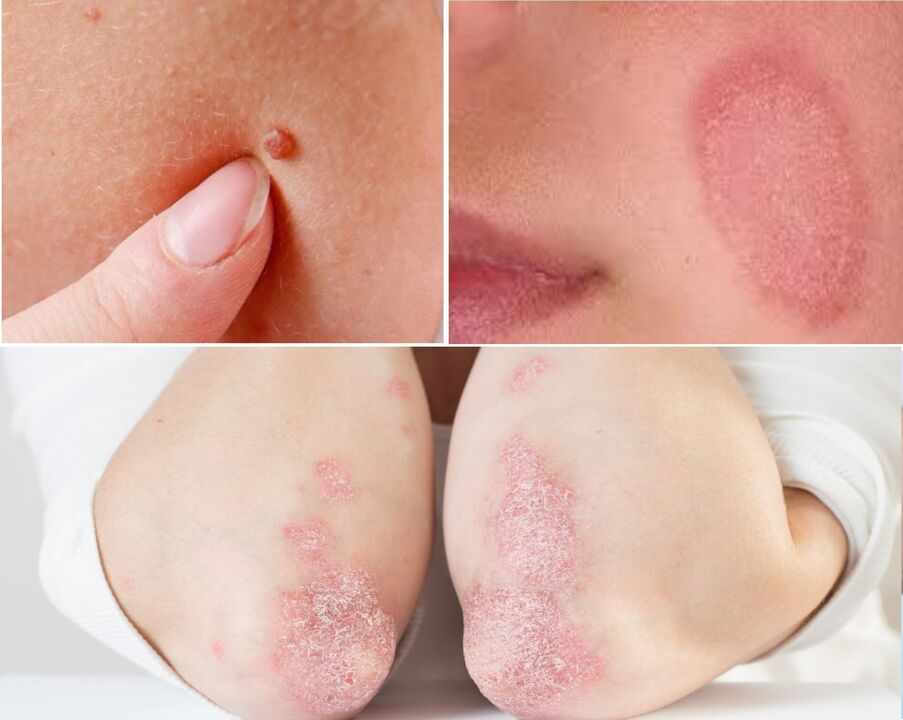 La keramina es eficaz contra papilomas, hongos y psoriasis.