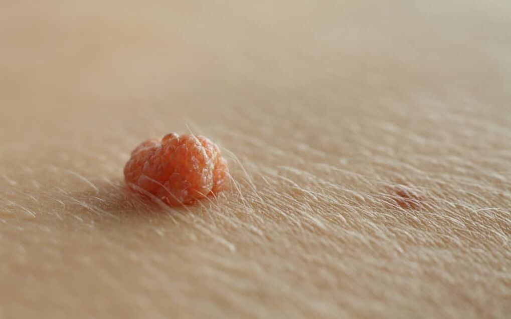 Papiloma