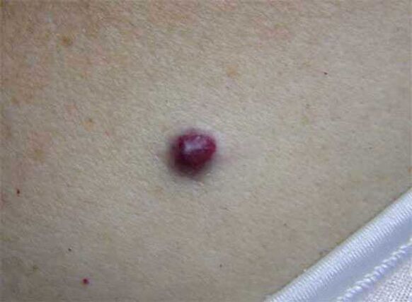 Marca de nacimiento roja en el cuerpo.