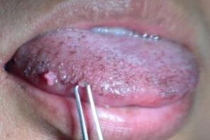 Papilomas en la lengua