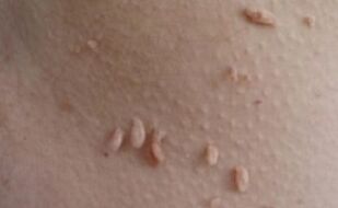 Papilomas filiformes