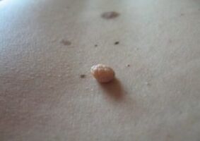 Un papiloma es un crecimiento en la superficie de la piel.