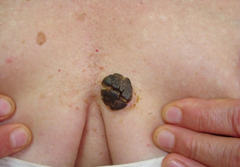 Queratoma en el cuerpo humano.