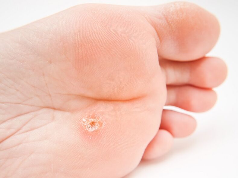 Verruga plantar a pie