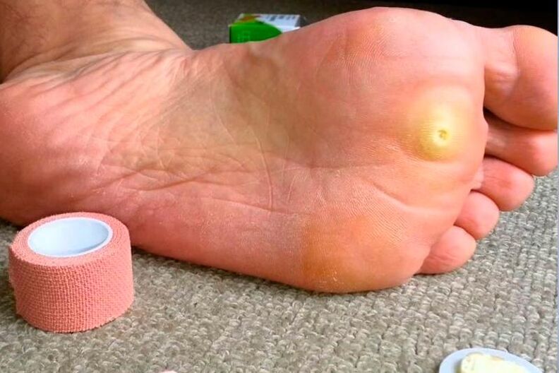 Verruga plantar a pie