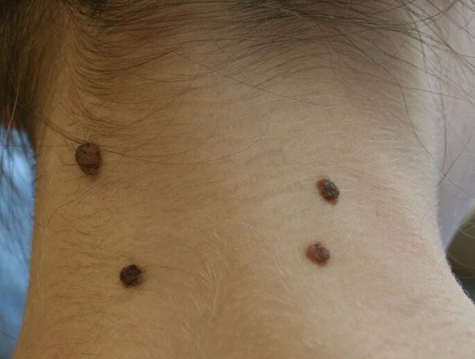 ¿Cómo se ven los papilomas en el cuello