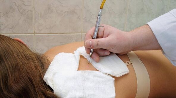 Electrocoagulación de papilomas en la espalda.